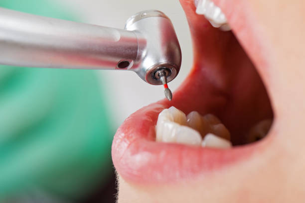 Best Emergency Tooth Extraction in Orem, UT